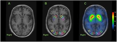 The Relationship Between the Striatal Dopaminergic Neuronal and Cognitive Function With Aging